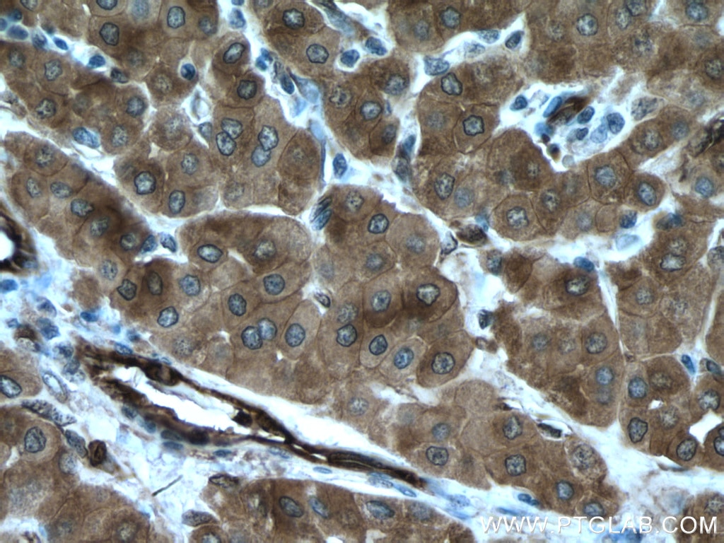 Immunohistochemistry (IHC) staining of human liver cancer tissue using TGM2 Polyclonal antibody (15100-1-AP)