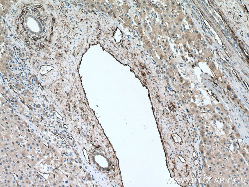 Immunohistochemistry (IHC) staining of human liver cancer tissue using TGM2 Polyclonal antibody (15100-1-AP)