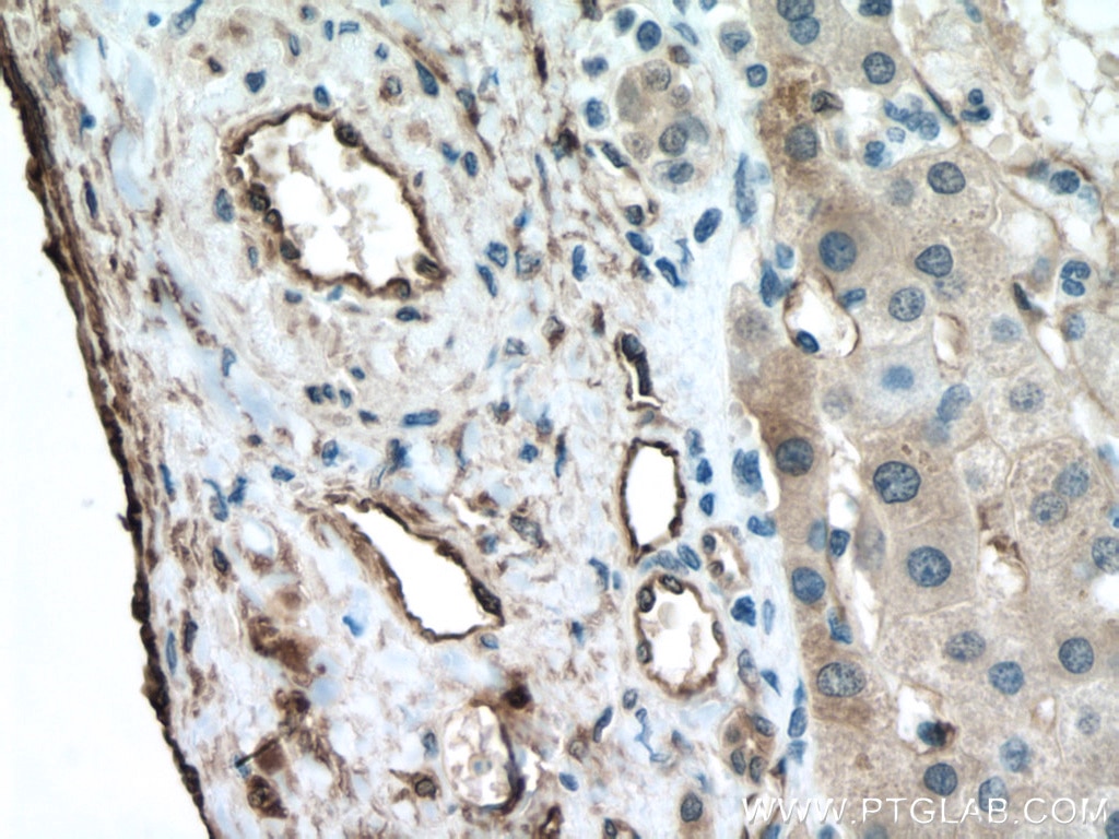 Immunohistochemistry (IHC) staining of human liver cancer tissue using TGM2 Polyclonal antibody (15100-1-AP)