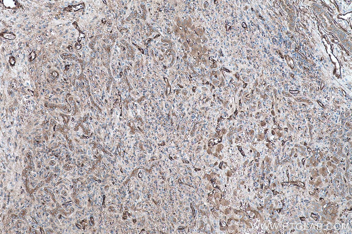 Immunohistochemistry (IHC) staining of human liver cancer tissue using TGM2 Monoclonal antibody (68006-1-Ig)
