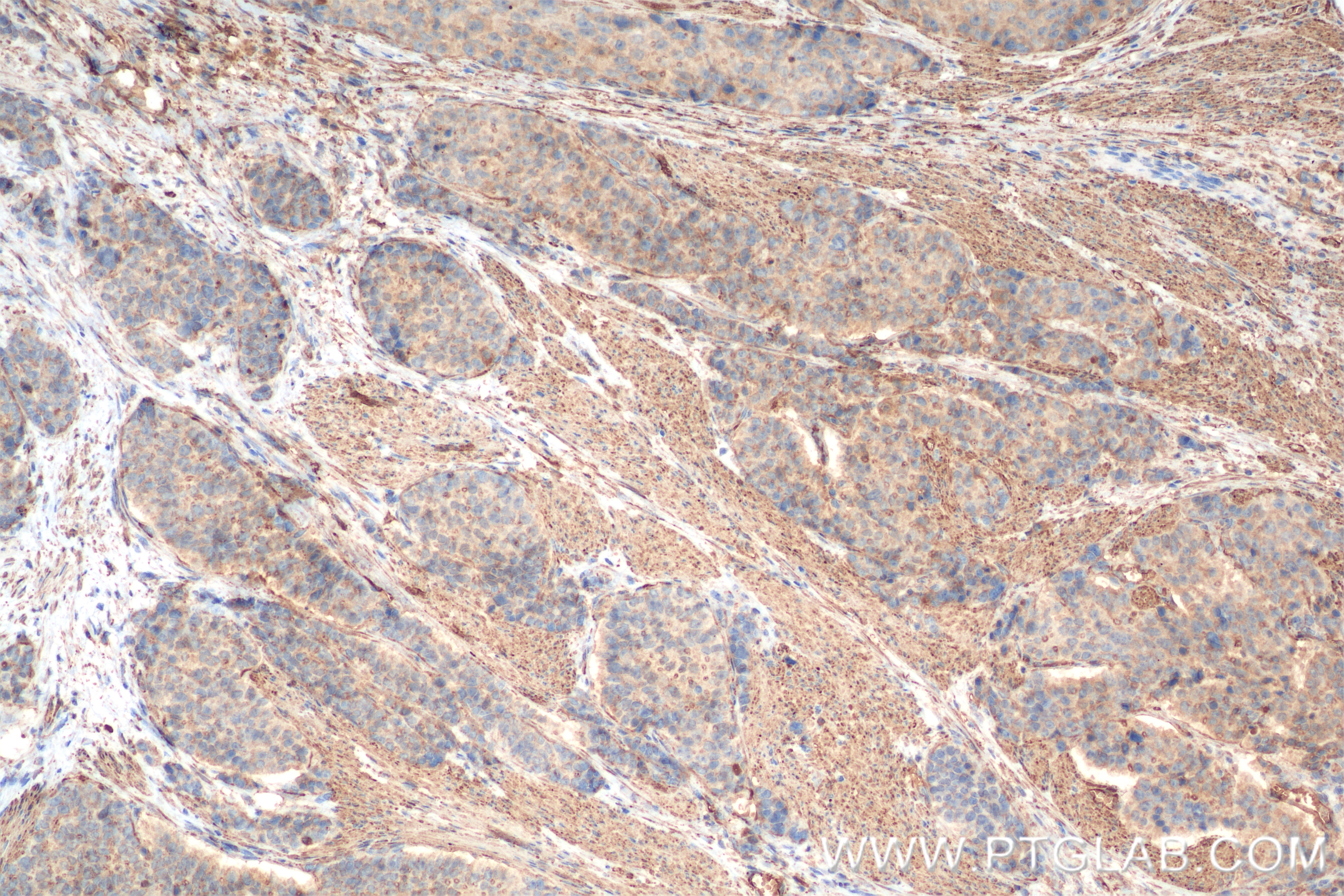 Immunohistochemistry (IHC) staining of human stomach cancer tissue using TGM2 Recombinant antibody (82552-4-RR)