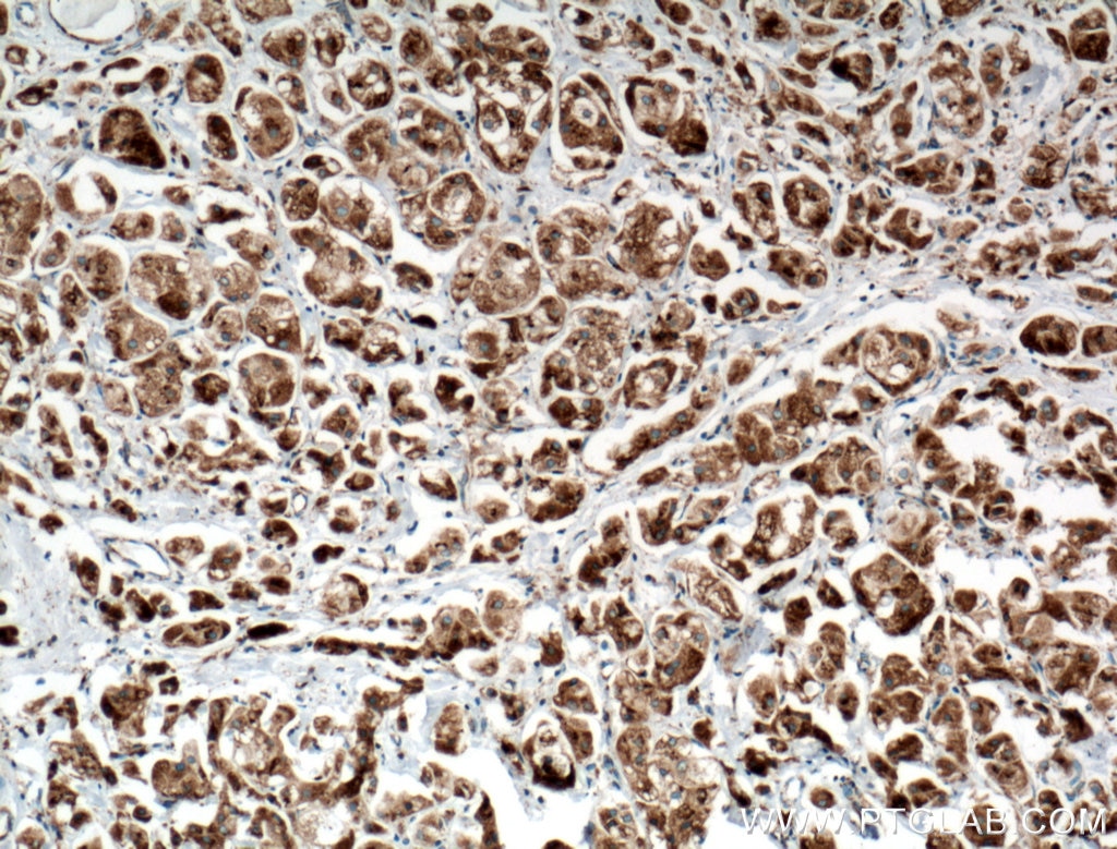 Immunohistochemistry (IHC) staining of human breast cancer tissue using TGN46 Monoclonal antibody (66477-1-Ig)