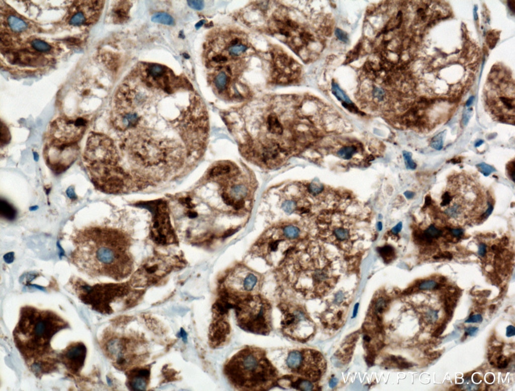 Immunohistochemistry (IHC) staining of human breast cancer tissue using TGN46 Monoclonal antibody (66477-1-Ig)