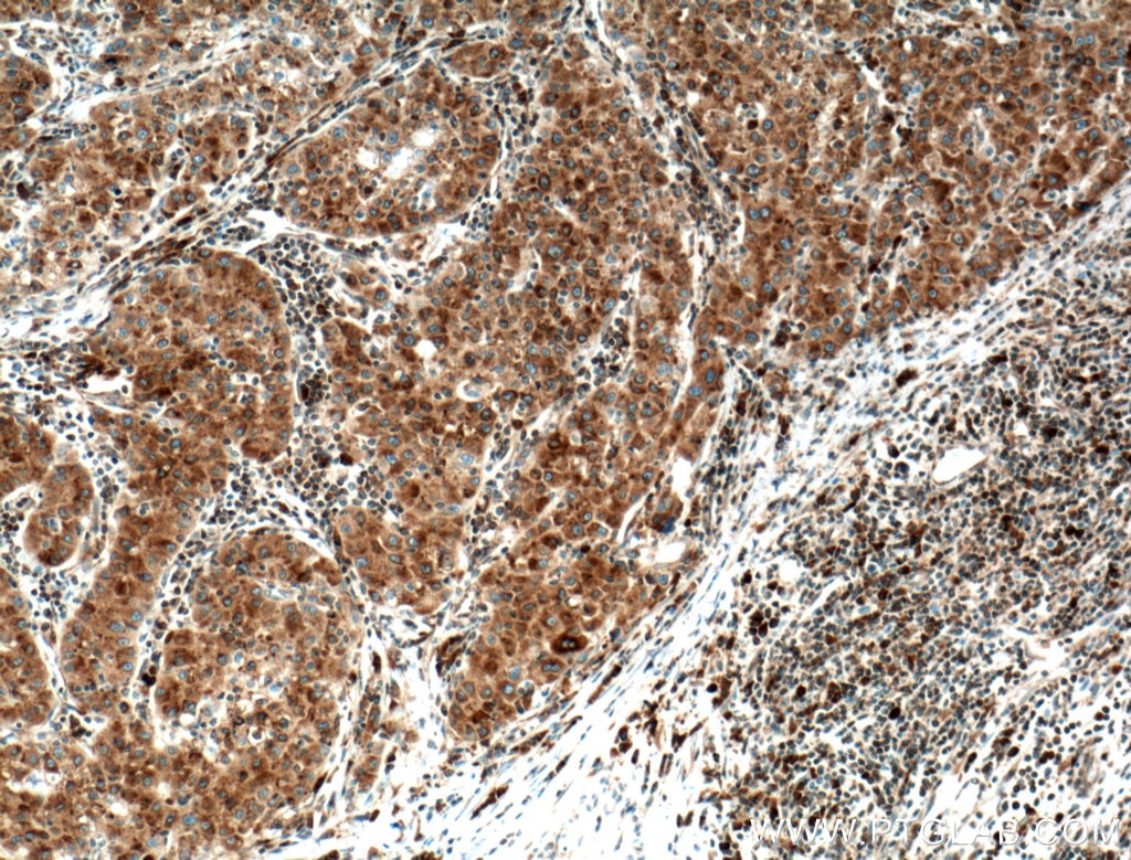 Immunohistochemistry (IHC) staining of human liver cancer tissue using TGN46 Monoclonal antibody (66477-1-Ig)