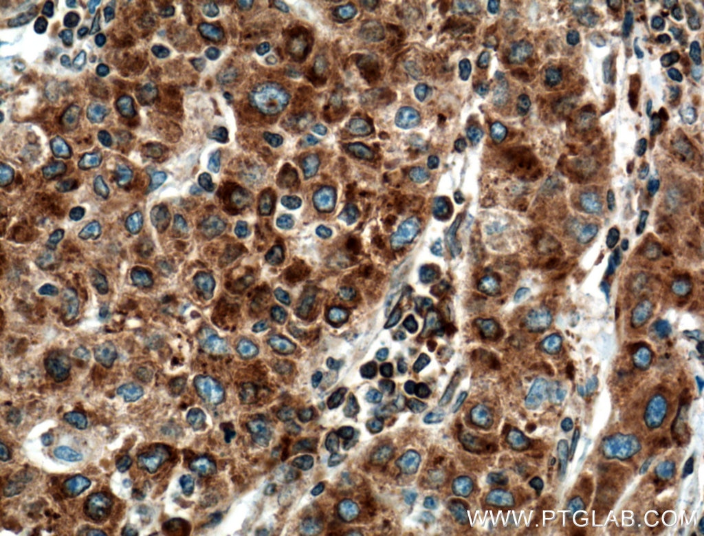 Immunohistochemistry (IHC) staining of human liver cancer tissue using TGN46 Monoclonal antibody (66477-1-Ig)