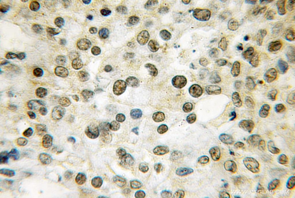 Immunohistochemistry (IHC) staining of human colon cancer tissue using THAP1 Polyclonal antibody (12584-1-AP)