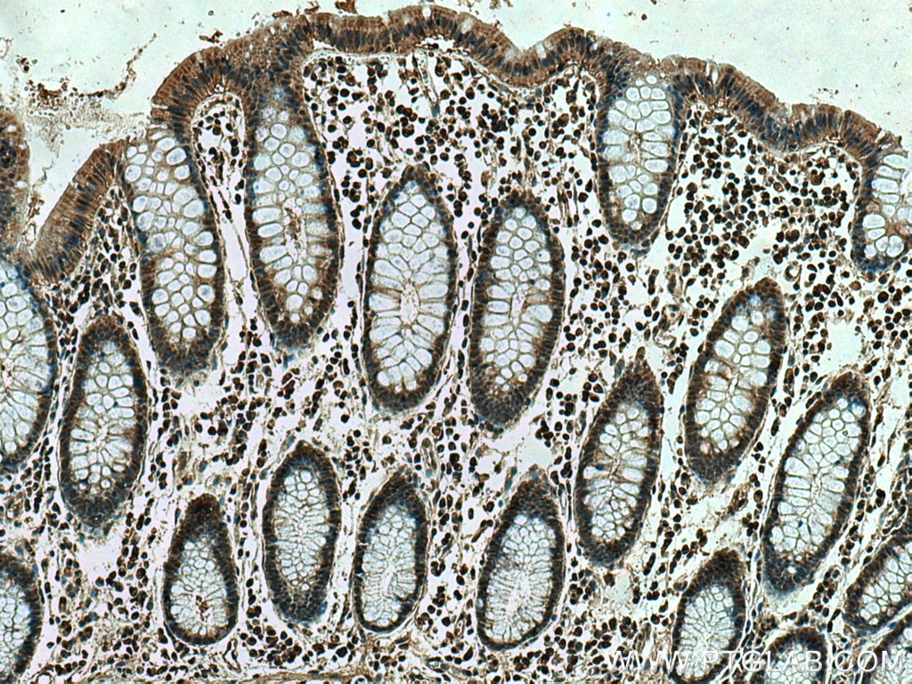 IHC staining of human colon cancer using 23030-1-AP