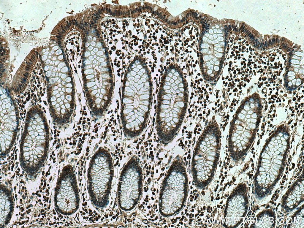 Immunohistochemistry (IHC) staining of human colon cancer tissue using THAP11 Polyclonal antibody (23030-1-AP)