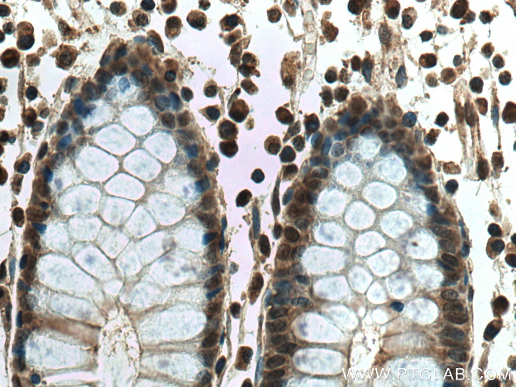 Immunohistochemistry (IHC) staining of human colon cancer tissue using THAP11 Polyclonal antibody (23030-1-AP)