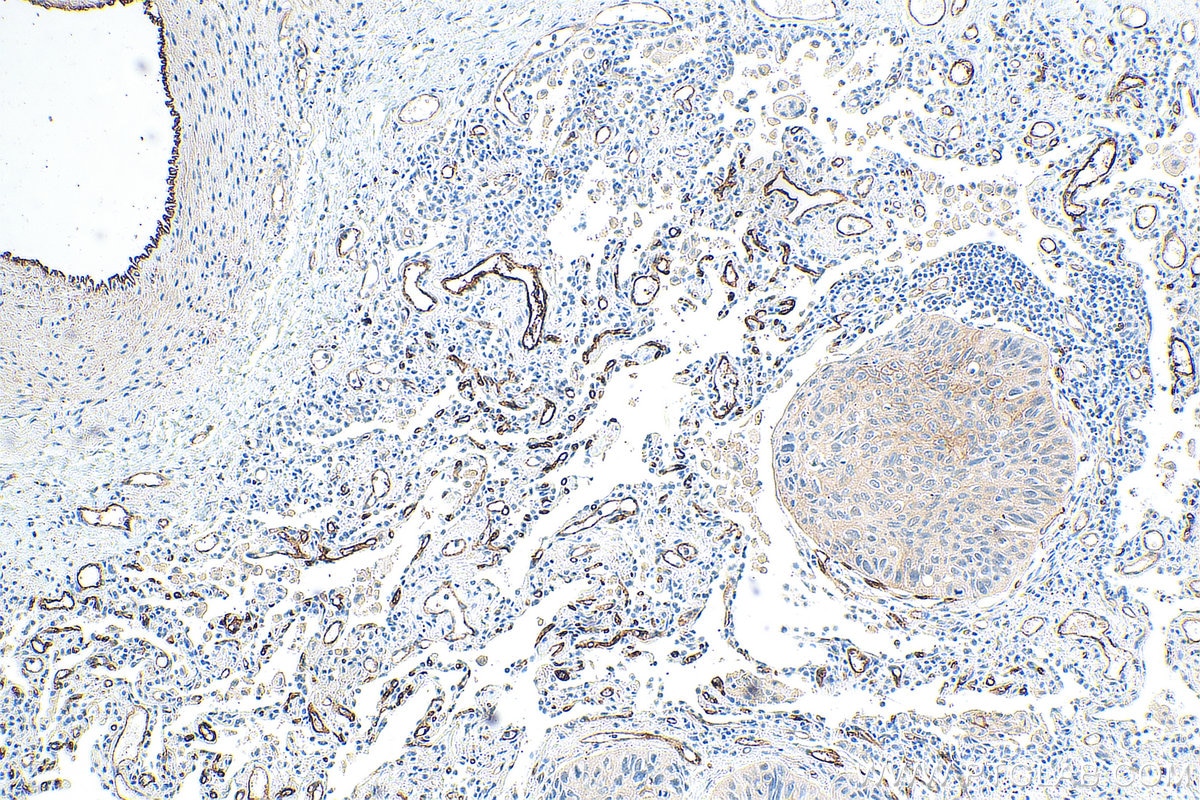 Immunohistochemistry (IHC) staining of human lung cancer tissue using CD141/Thrombomodulin Monoclonal antibody (67831-1-Ig)