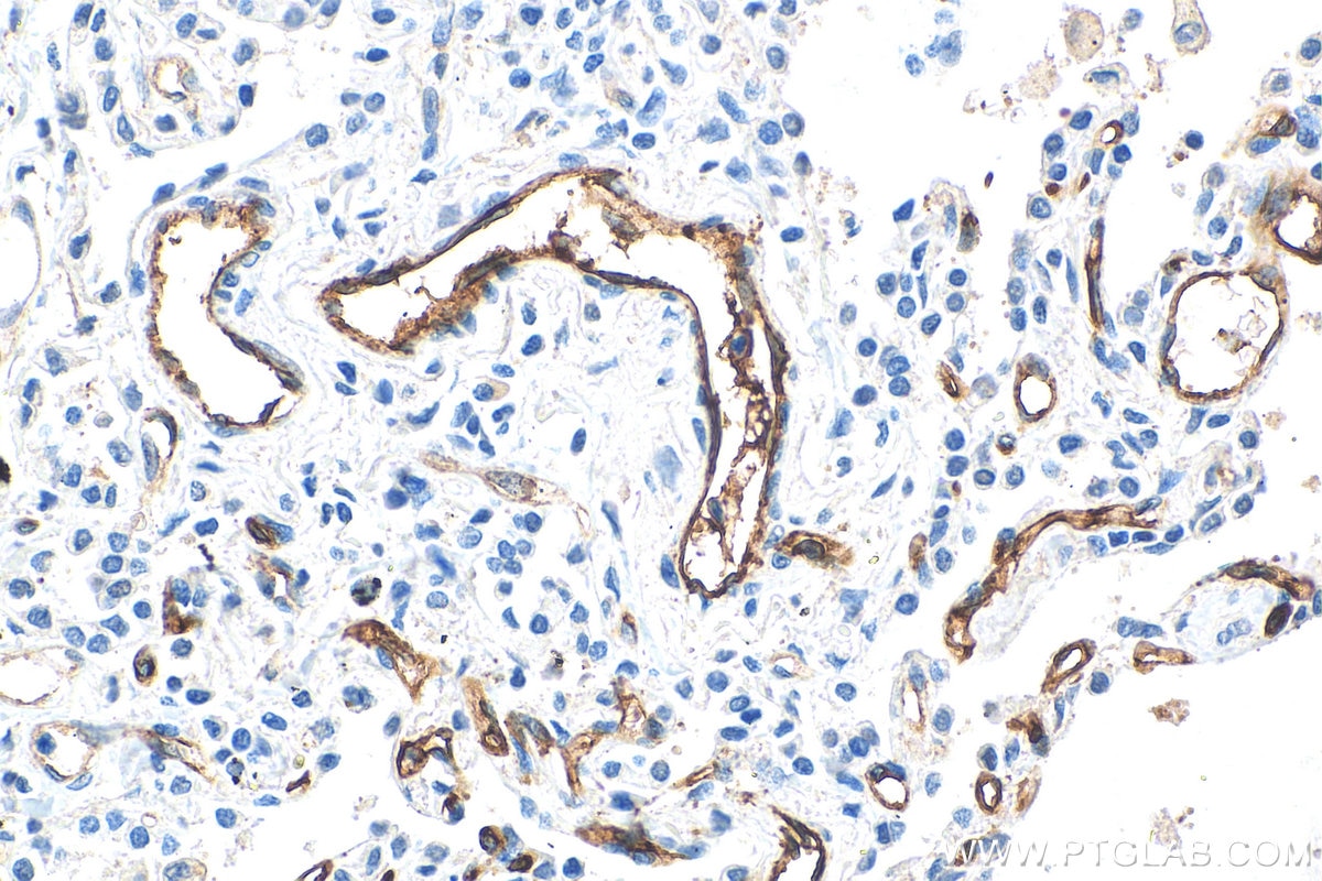 Immunohistochemistry (IHC) staining of human lung cancer tissue using THBD Monoclonal antibody (67831-1-Ig)