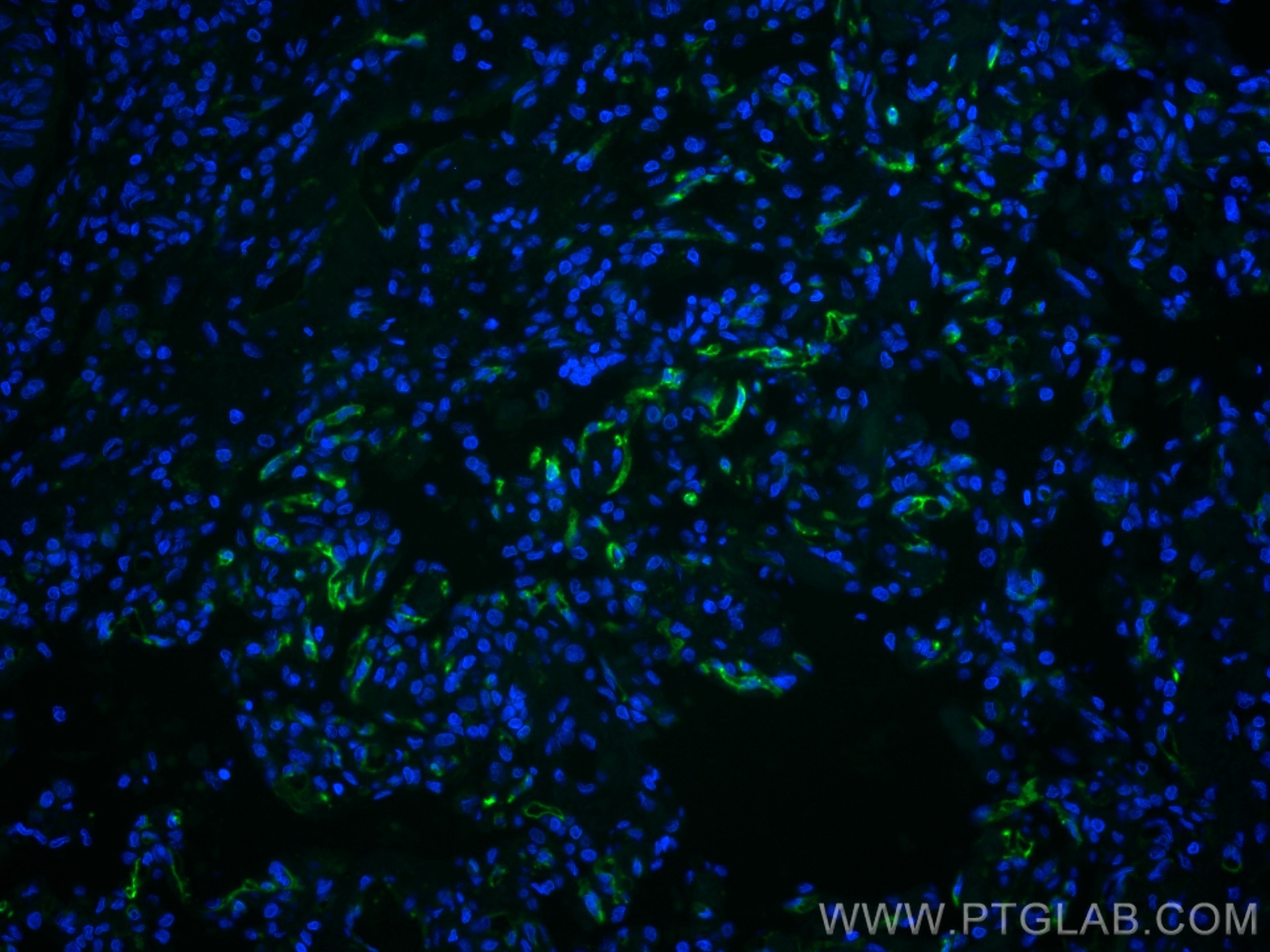 Immunofluorescence (IF) / fluorescent staining of human lung cancer tissue using CoraLite® Plus 488-conjugated THBD Monoclonal anti (CL488-67831)