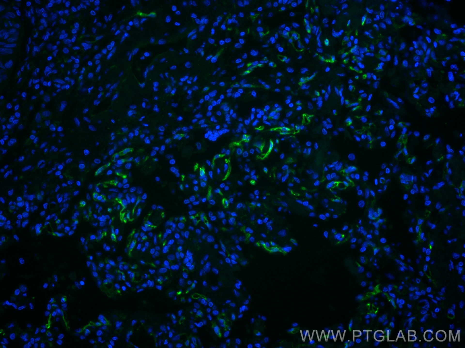 IF Staining of human lung cancer using CL488-67831