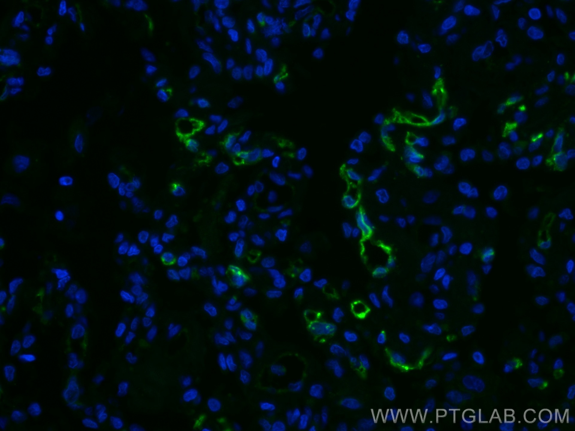 Immunofluorescence (IF) / fluorescent staining of human lung cancer tissue using CoraLite® Plus 488-conjugated THBD Monoclonal anti (CL488-67831)