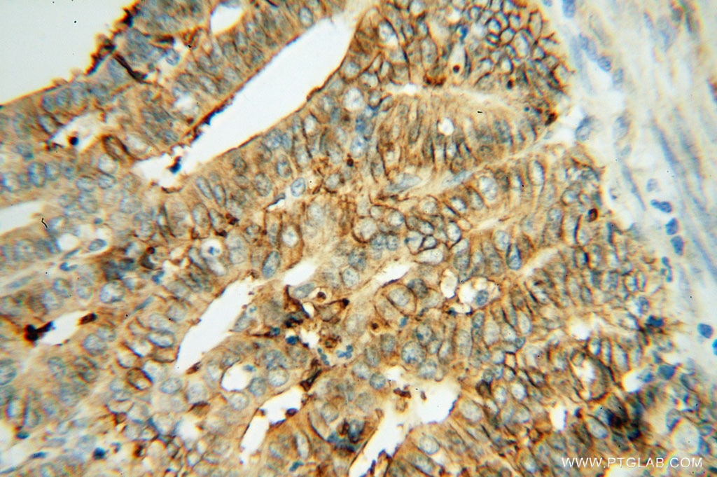 Immunohistochemistry (IHC) staining of human endometrial cancer tissue using CTMP Polyclonal antibody (14692-1-AP)