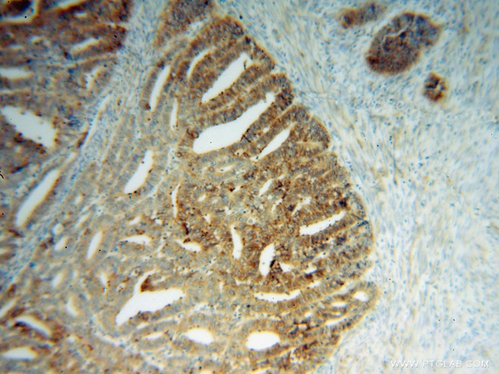 Immunohistochemistry (IHC) staining of human endometrial cancer tissue using CTMP Polyclonal antibody (14692-1-AP)