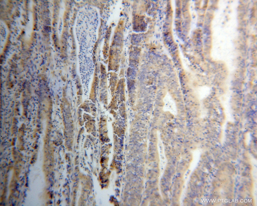 Immunohistochemistry (IHC) staining of human endometrial cancer tissue using THG1L Polyclonal antibody (15208-1-AP)