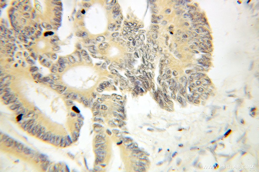 Immunohistochemistry (IHC) staining of human colon cancer tissue using THOC1 Polyclonal antibody (10920-1-AP)