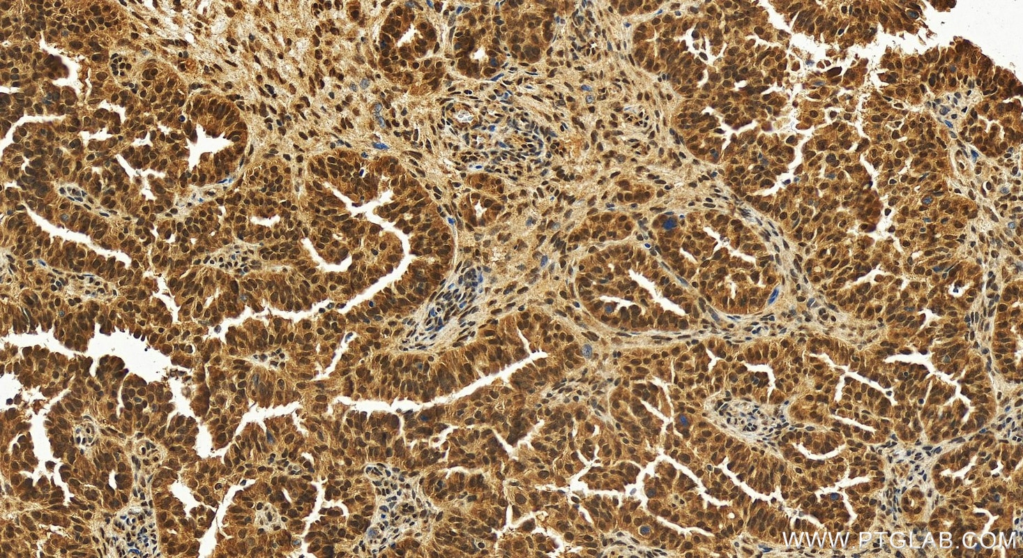 Immunohistochemistry (IHC) staining of human ovary cancer tissue using THOC3 Polyclonal antibody (11716-1-AP)