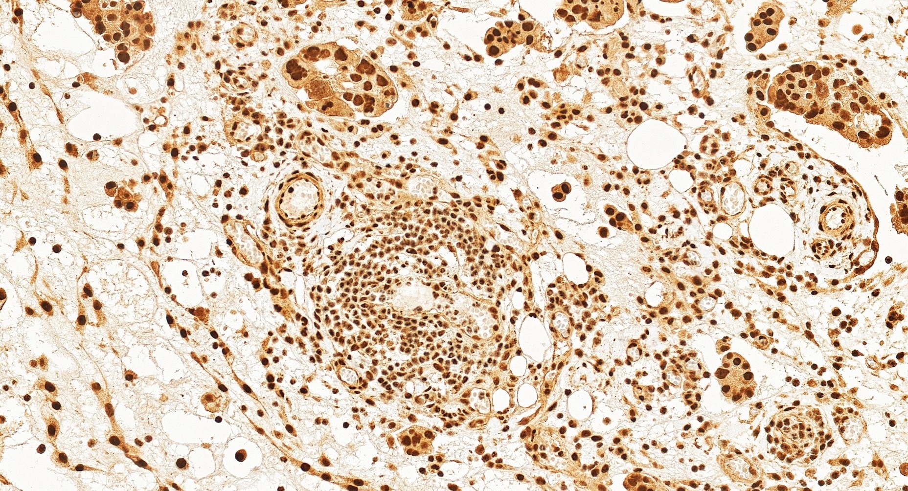Immunohistochemistry (IHC) staining of human ovary cancer tissue using THOC3 Monoclonal antibody (68812-3-Ig)