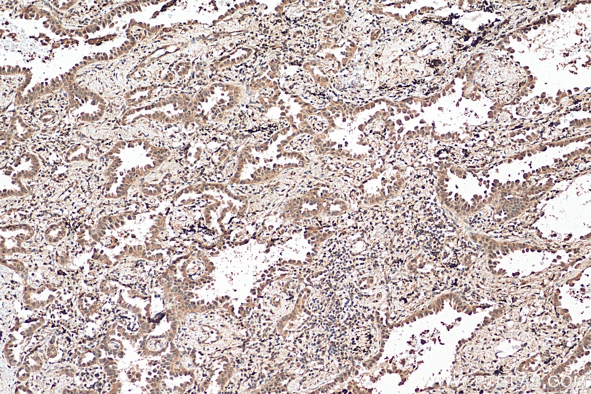 Immunohistochemistry (IHC) staining of human lung cancer tissue using THOC5 Polyclonal antibody (14862-1-AP)