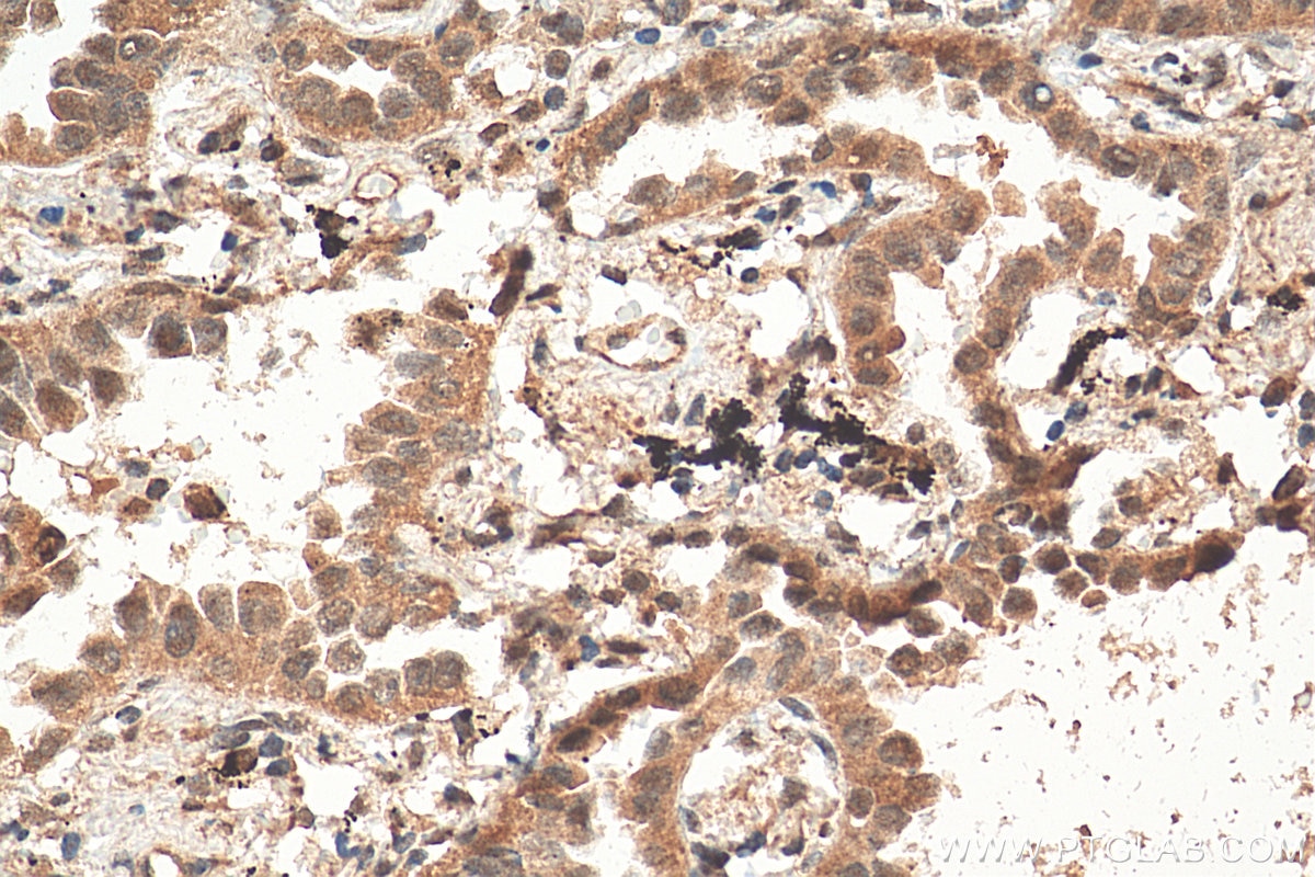 Immunohistochemistry (IHC) staining of human lung cancer tissue using THOC5 Polyclonal antibody (14862-1-AP)