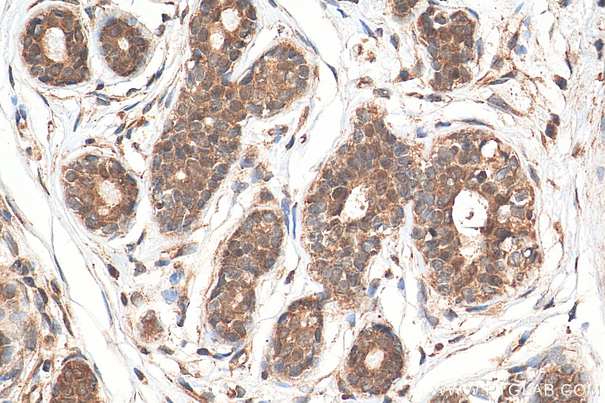 Immunohistochemistry (IHC) staining of human breast cancer tissue using THOC5 Polyclonal antibody (14862-1-AP)