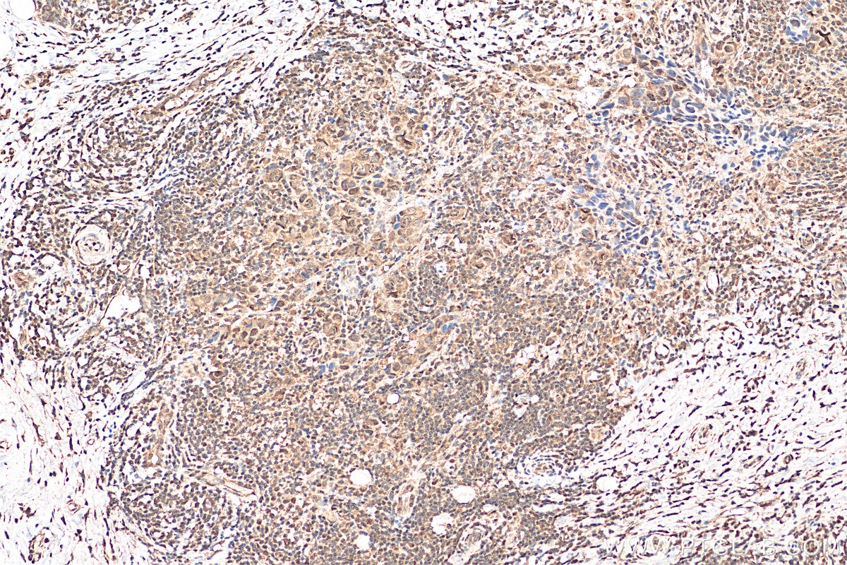Immunohistochemistry (IHC) staining of human breast cancer tissue using THOC5 Polyclonal antibody (14862-1-AP)