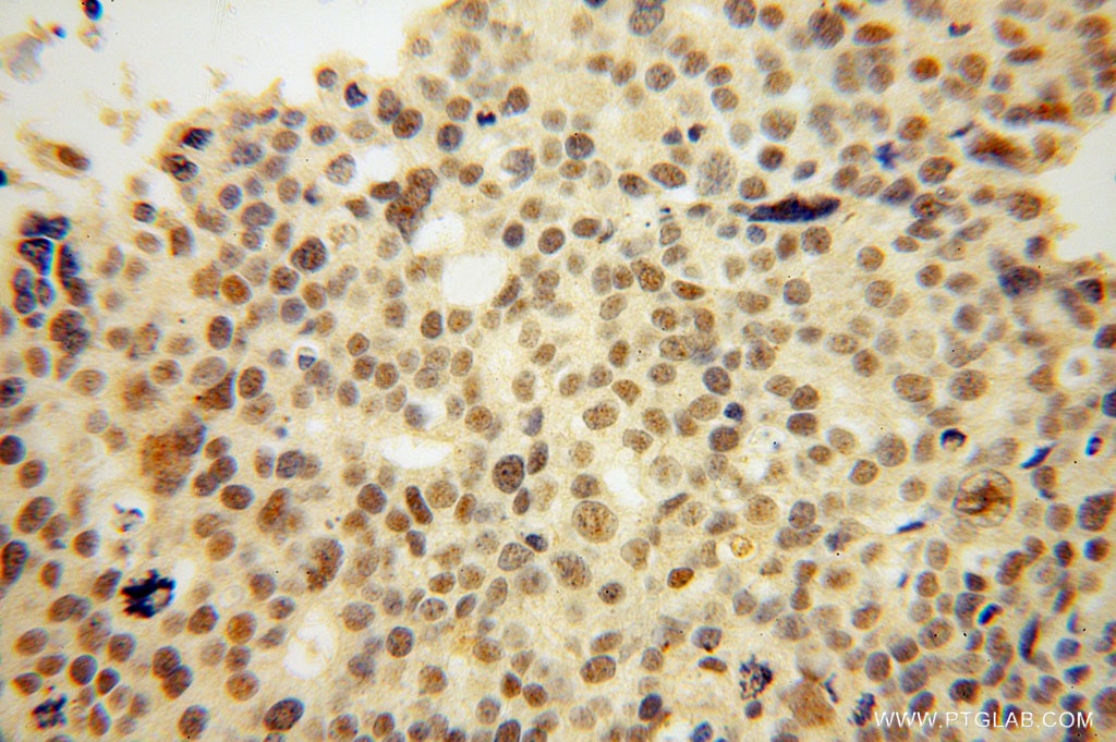 Immunohistochemistry (IHC) staining of human ovary tumor tissue using THOC6 Polyclonal antibody (15316-1-AP)