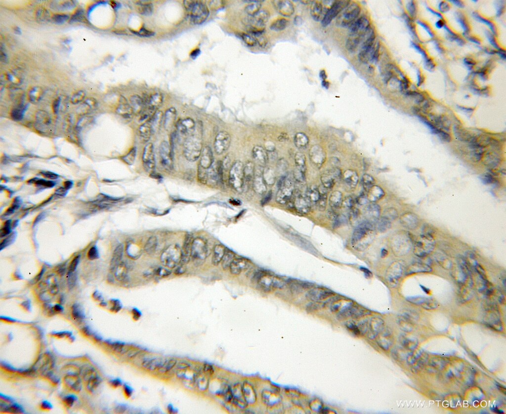 Immunohistochemistry (IHC) staining of human colon cancer tissue using THOP1 Polyclonal antibody (11738-1-AP)