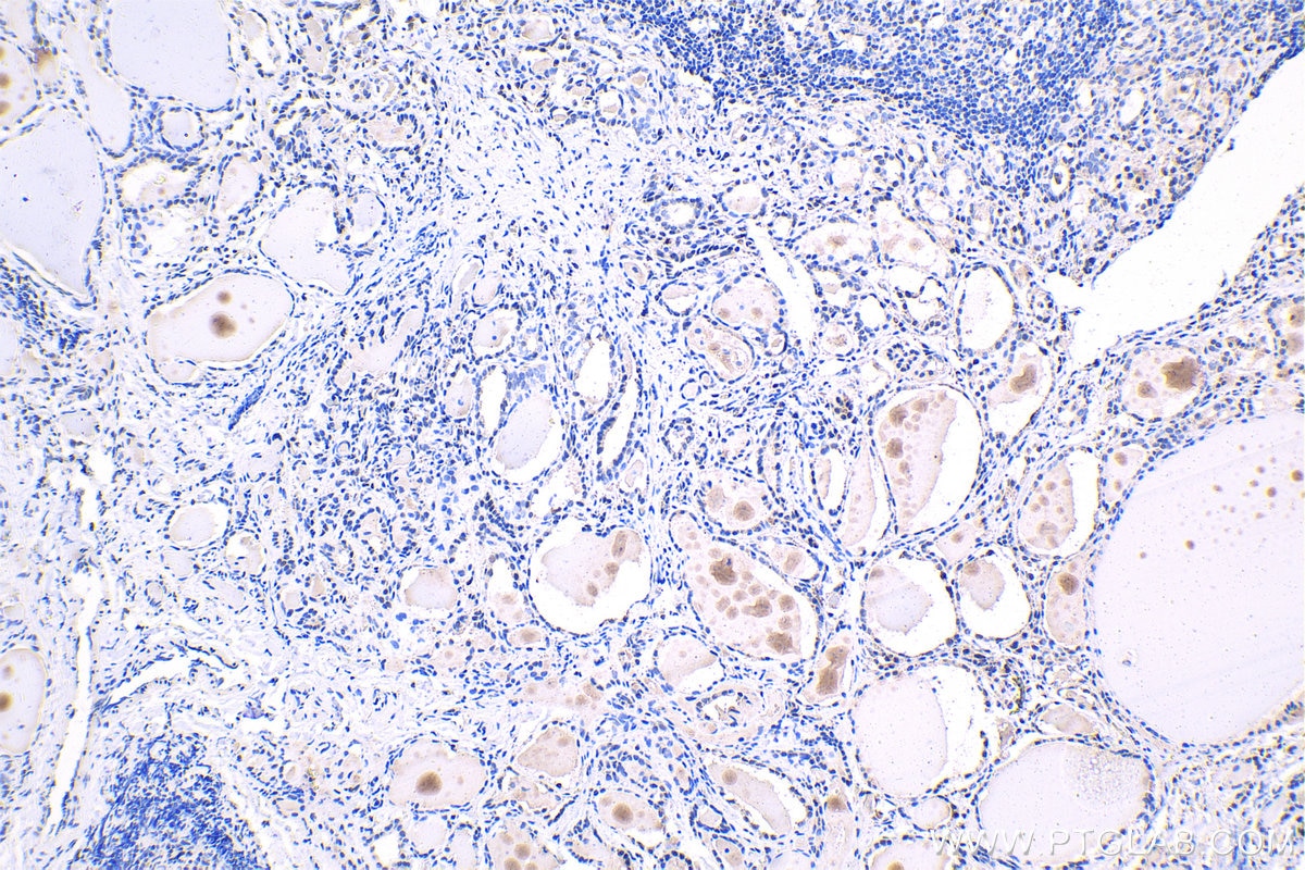Immunohistochemistry (IHC) staining of human thyroid cancer tissue using THRA Monoclonal antibody (66703-1-Ig)