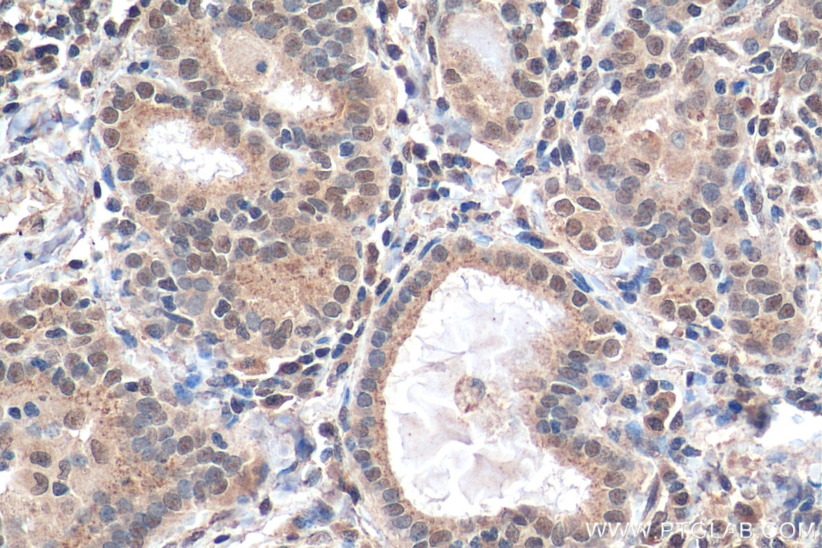 Immunohistochemistry (IHC) staining of human thyroid cancer tissue using THRAP3 Polyclonal antibody (19744-1-AP)
