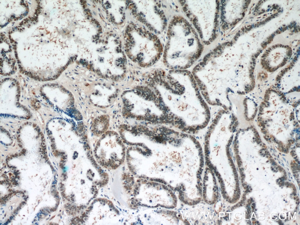 Immunohistochemistry (IHC) staining of human ovary tumor tissue using THRAP3 Polyclonal antibody (19744-1-AP)