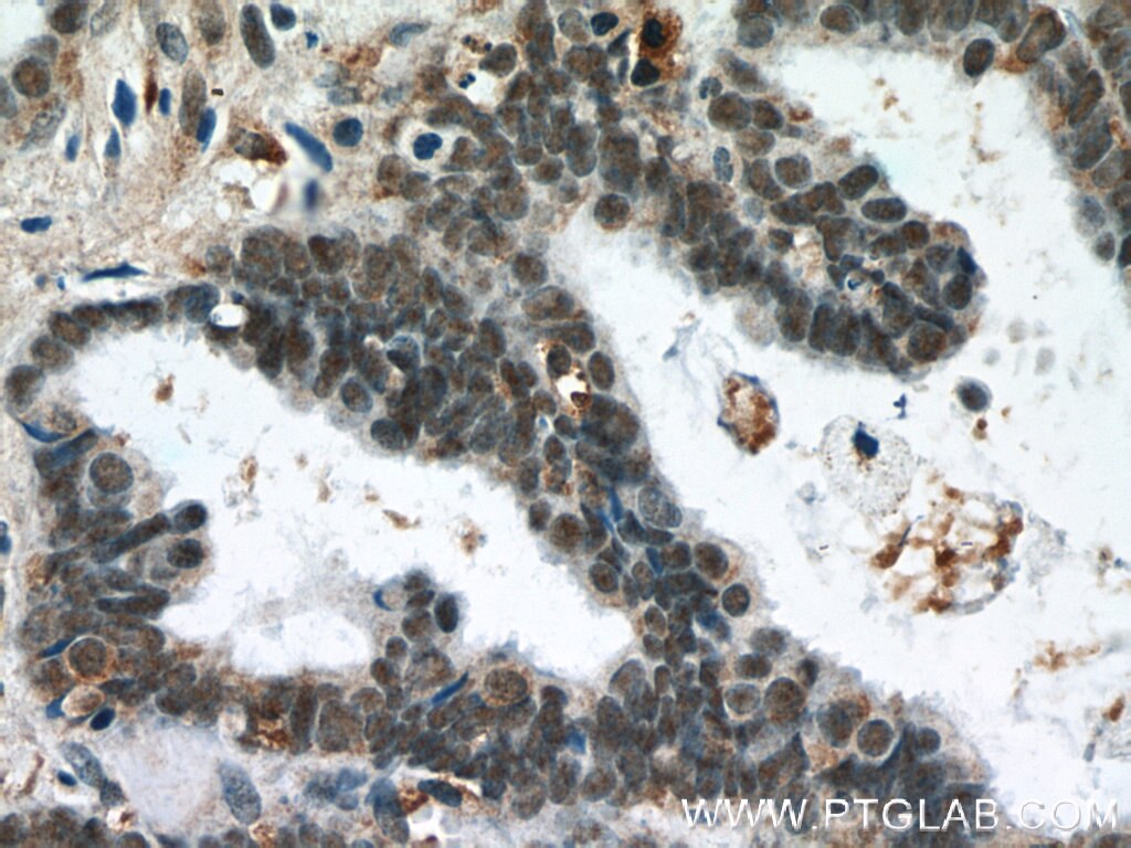 Immunohistochemistry (IHC) staining of human ovary tumor tissue using THRAP3 Polyclonal antibody (19744-1-AP)