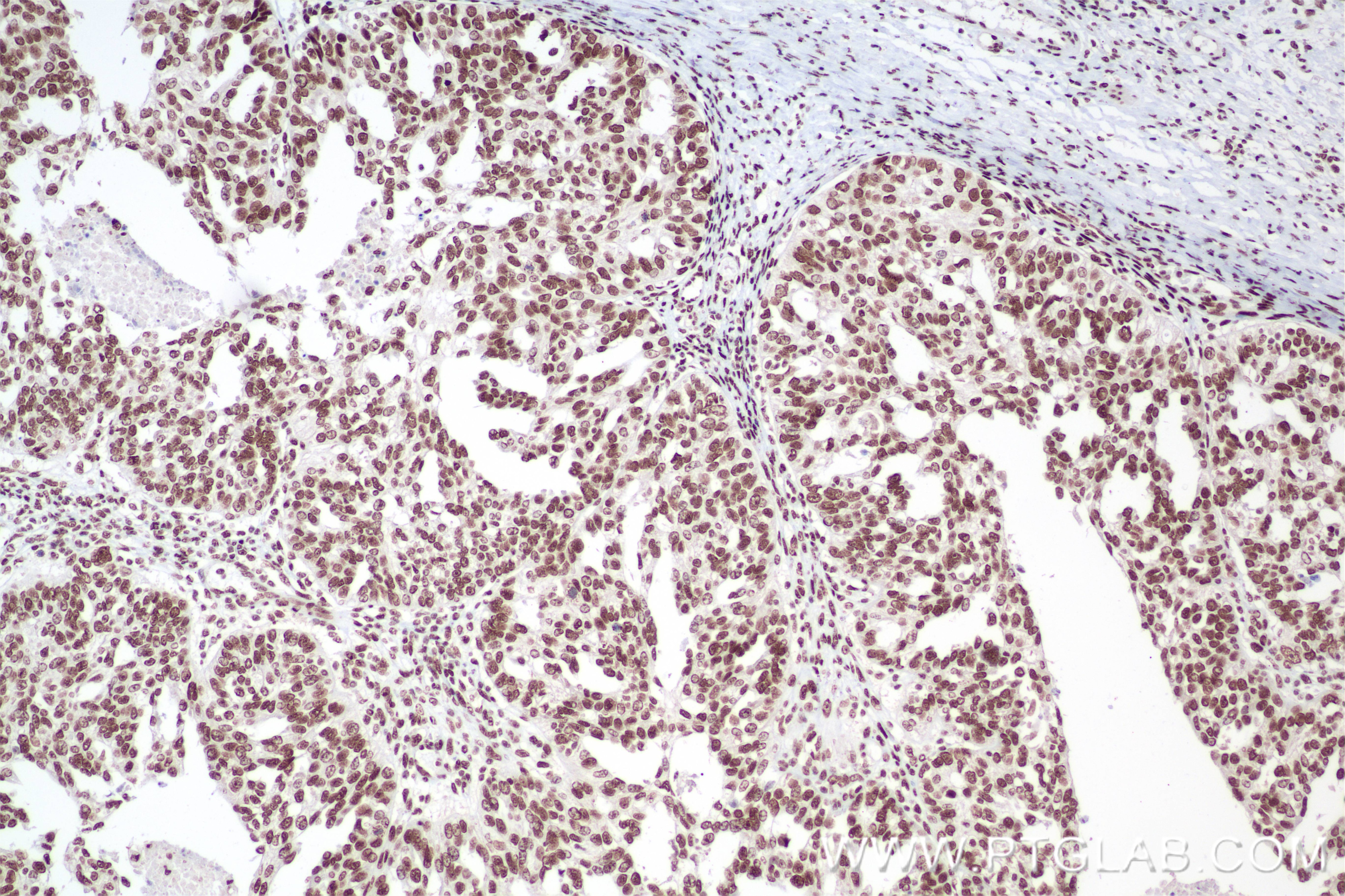 Immunohistochemistry (IHC) staining of human ovary cancer tissue using THRAP3 Recombinant antibody (85093-1-RR)