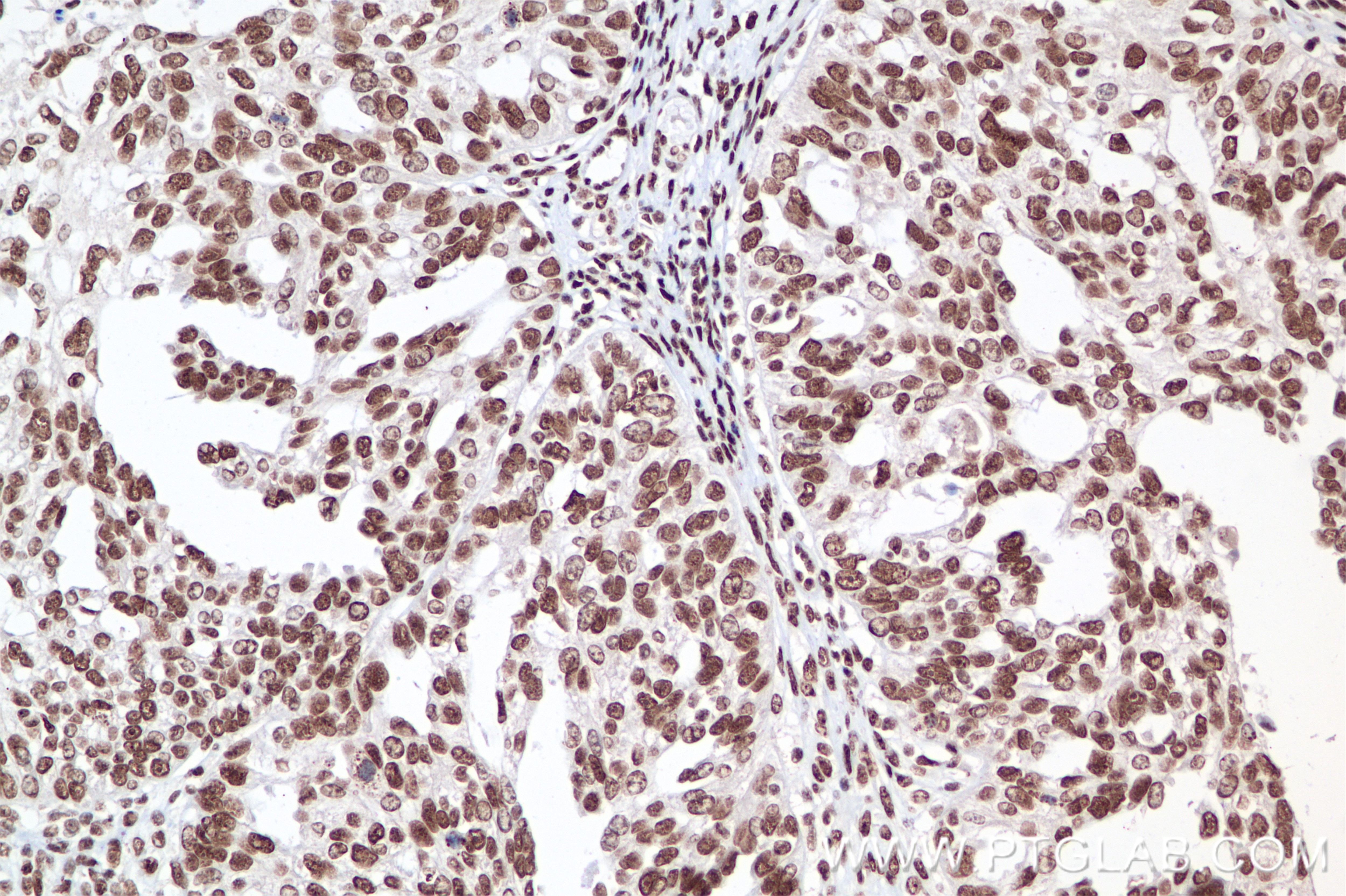 Immunohistochemistry (IHC) staining of human ovary cancer tissue using THRAP3 Recombinant antibody (85093-1-RR)
