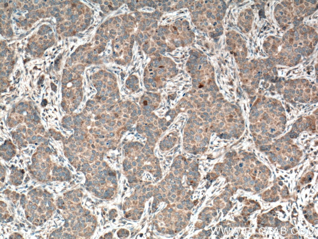 Immunohistochemistry (IHC) staining of human breast cancer tissue using THRSP Polyclonal antibody (13054-1-AP)