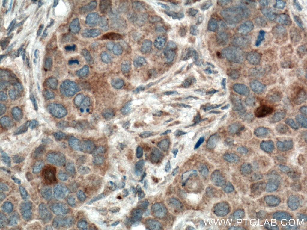 Immunohistochemistry (IHC) staining of human breast cancer tissue using THRSP Polyclonal antibody (13054-1-AP)