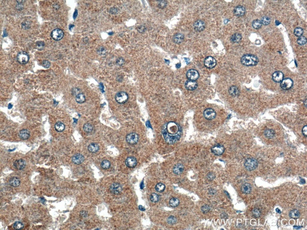 Immunohistochemistry (IHC) staining of human liver cancer tissue using THRSP Polyclonal antibody (13054-1-AP)