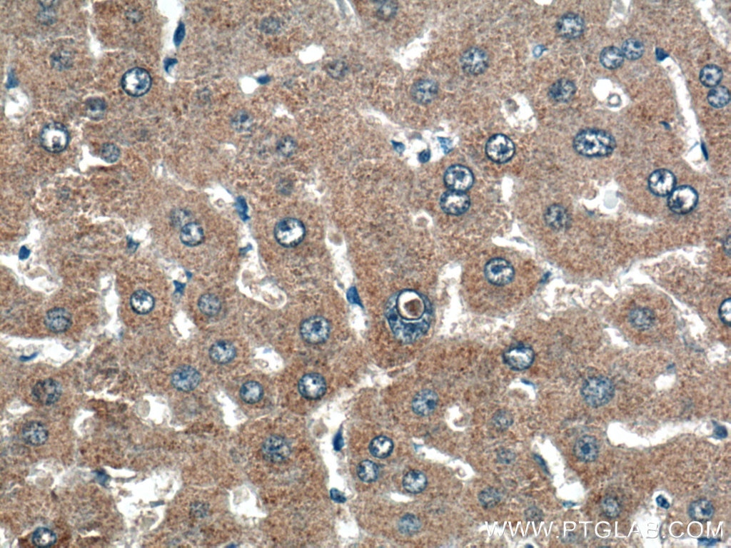 IHC staining of human liver cancer using 13054-1-AP