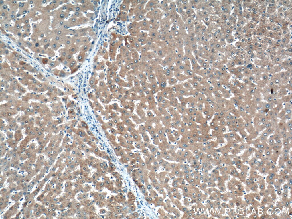 Immunohistochemistry (IHC) staining of human liver cancer tissue using THRSP Polyclonal antibody (13054-1-AP)