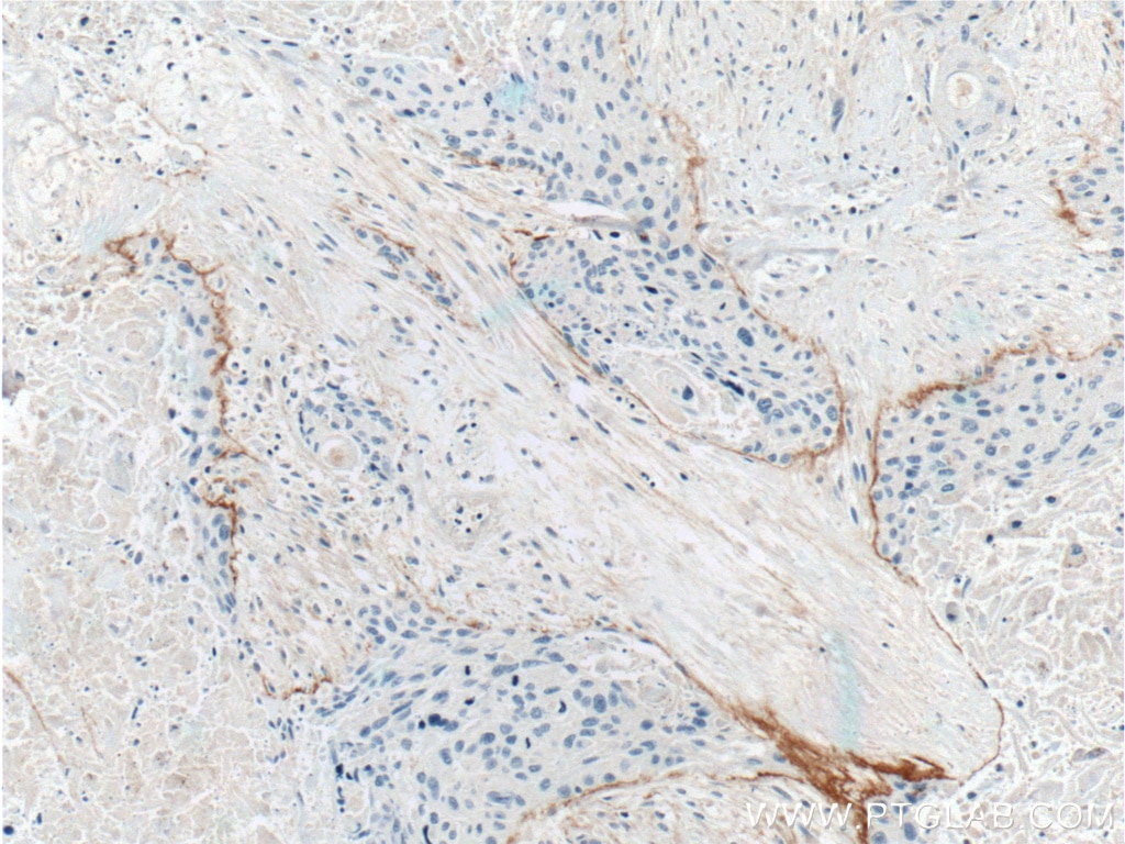 Immunohistochemistry (IHC) staining of human oesophagus cancer tissue using THSD4 Polyclonal antibody (20619-1-AP)