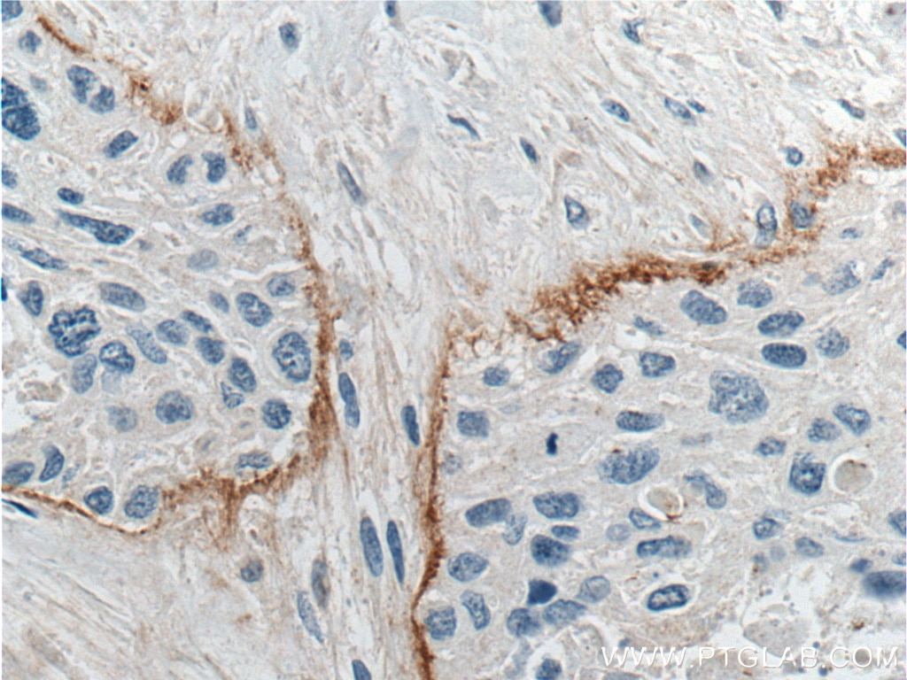 Immunohistochemistry (IHC) staining of human oesophagus cancer tissue using THSD4 Polyclonal antibody (20619-1-AP)
