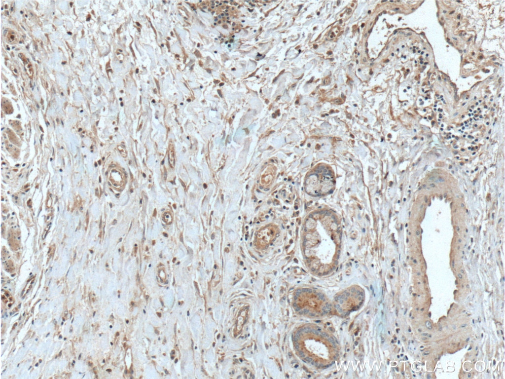 IHC staining of human oesophagus cancer using 20619-1-AP