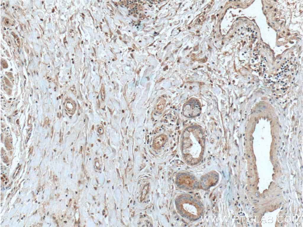 Immunohistochemistry (IHC) staining of human oesophagus cancer tissue using THSD4 Polyclonal antibody (20619-1-AP)