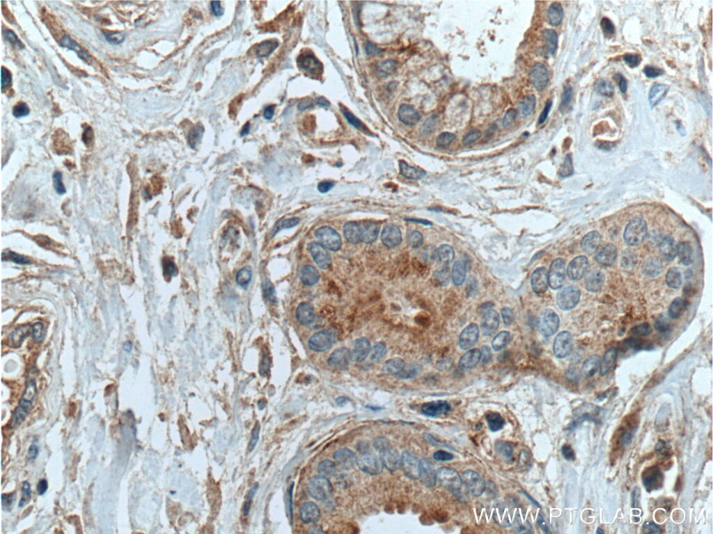 Immunohistochemistry (IHC) staining of human oesophagus cancer tissue using THSD4 Polyclonal antibody (20619-1-AP)