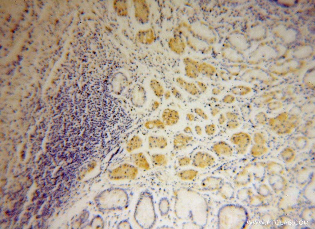 IHC staining of human stomach cancer using 15486-1-AP