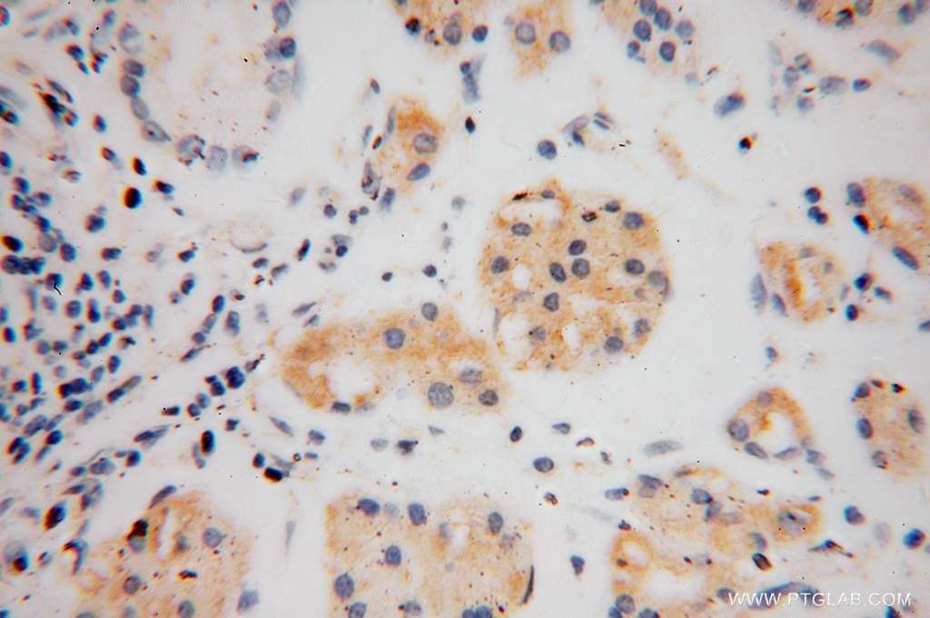 Immunohistochemistry (IHC) staining of human stomach cancer tissue using THTPA Polyclonal antibody (15486-1-AP)