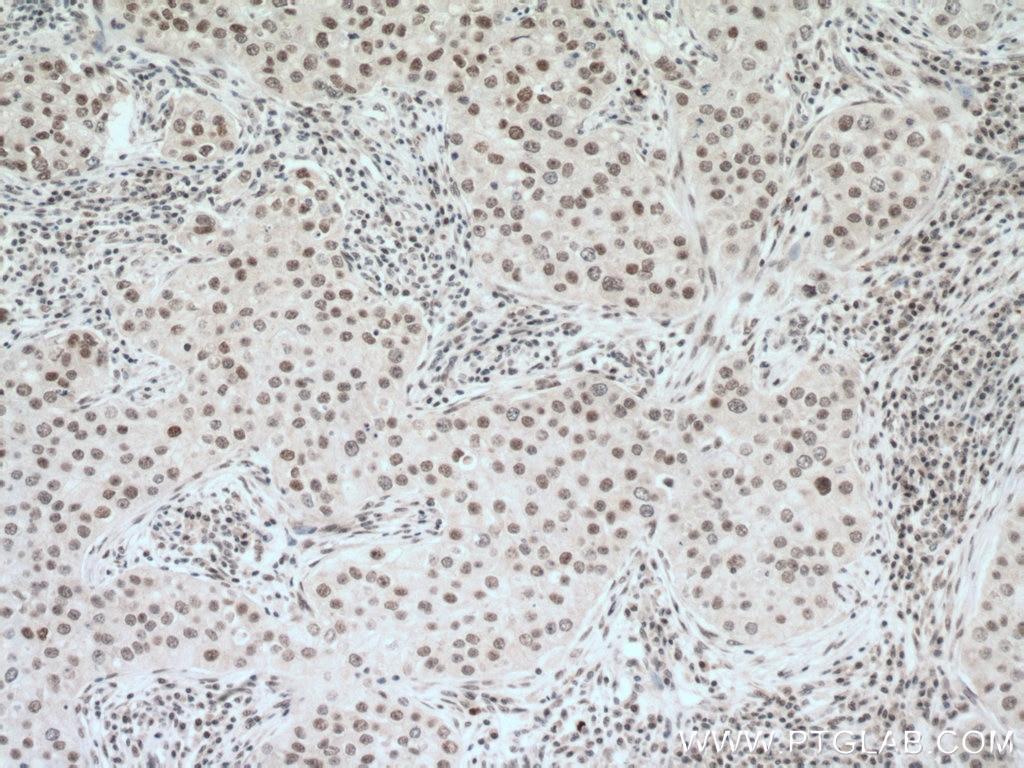Immunohistochemistry (IHC) staining of human breast cancer tissue using THUMPD1 Polyclonal antibody (14921-1-AP)