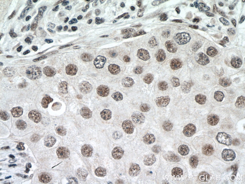Immunohistochemistry (IHC) staining of human breast cancer tissue using THUMPD1 Polyclonal antibody (14921-1-AP)